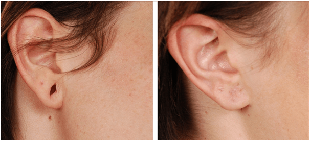 ear lobe