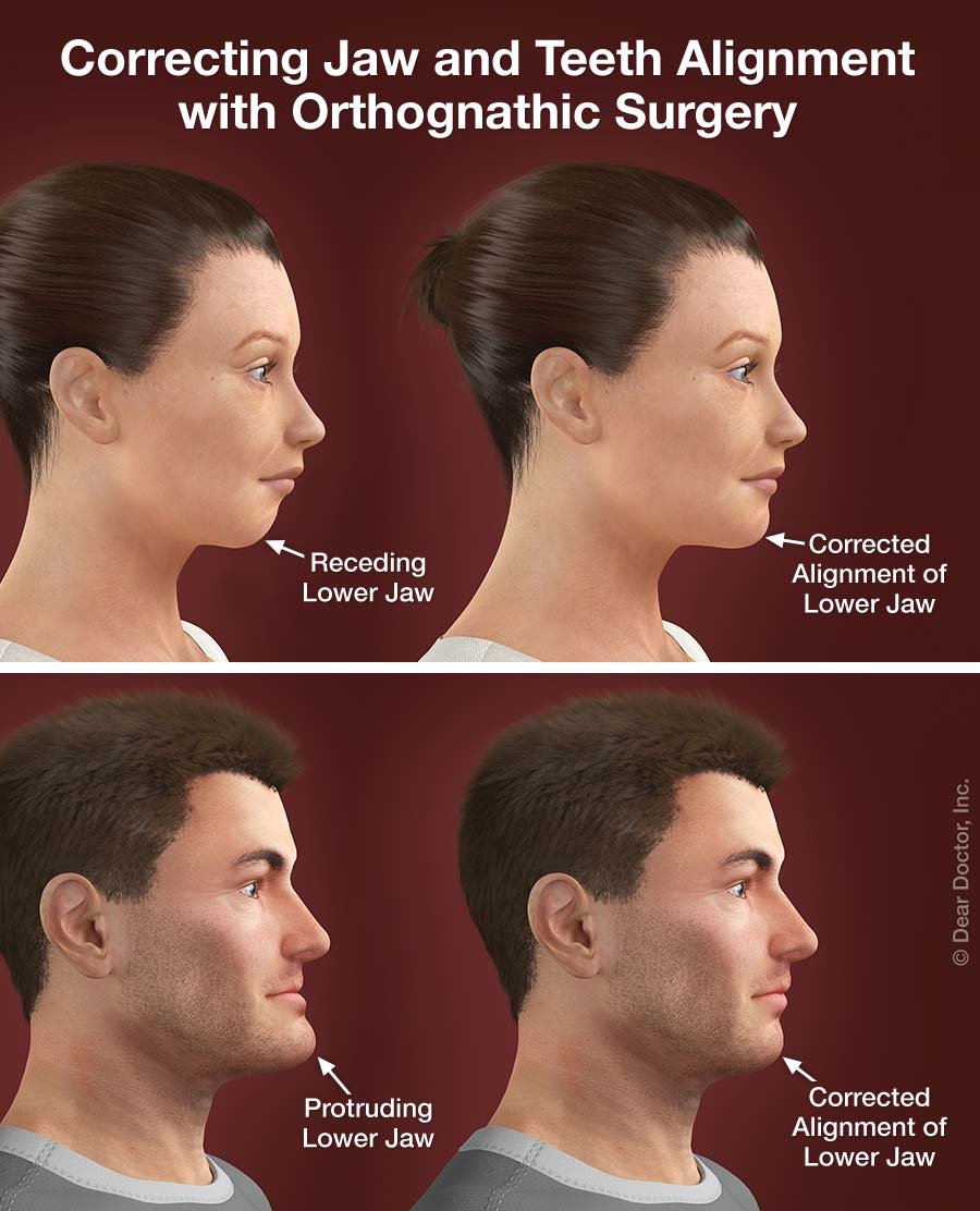 corrective-jaw-surgery