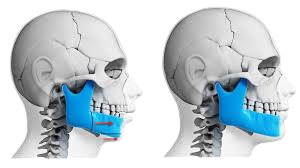 corrective jaw