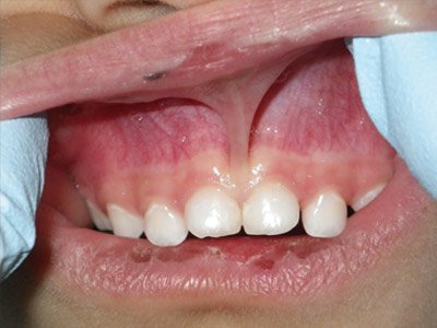 labial frenum