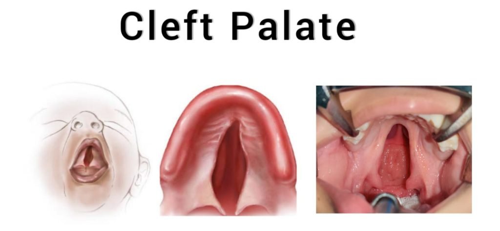 child with cleft palate
